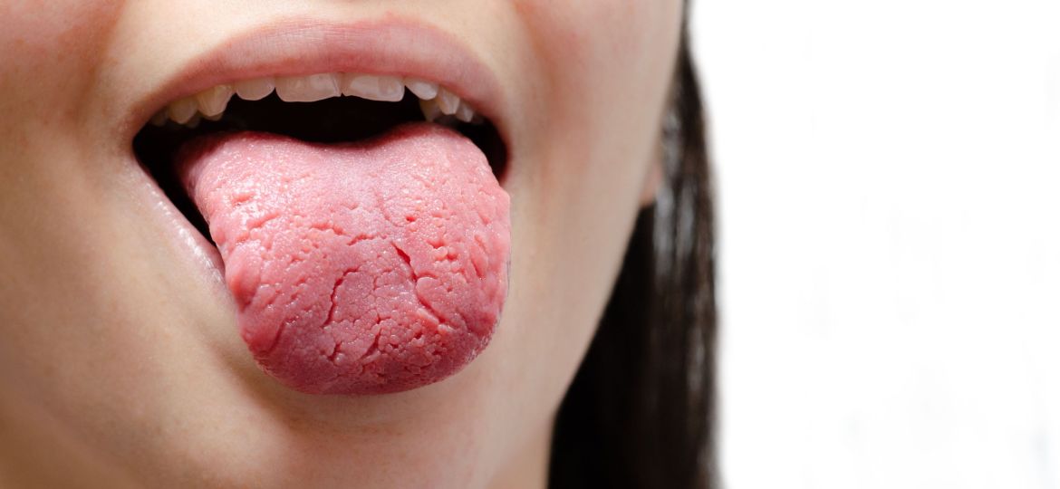 Tongue of a young Caucasian woman with benign migratory glossitis, candidiasis.