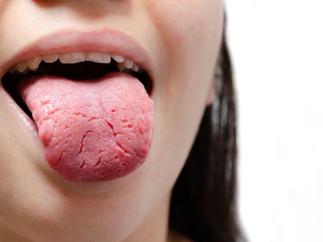 Tongue of a young Caucasian woman with benign migratory glossitis, candidiasis.